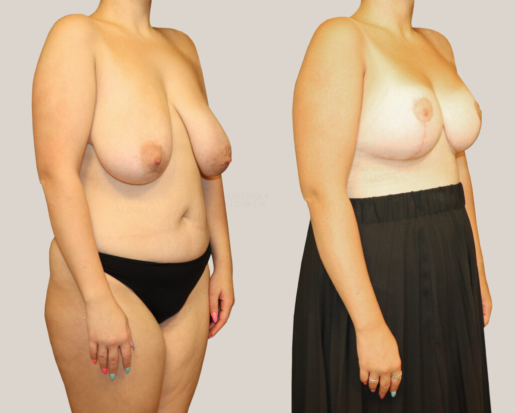 Bröstlyft-med-implantat-425cc.kvinna