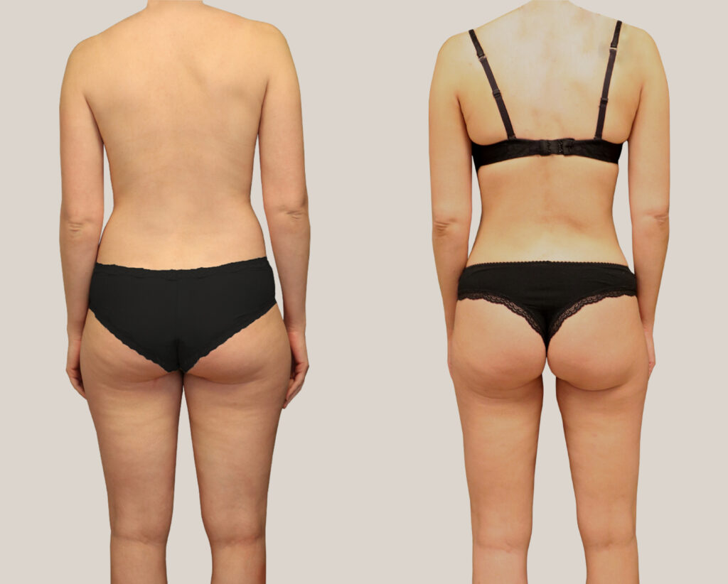fettsugning-kvinna-bakdel-bildgalleri