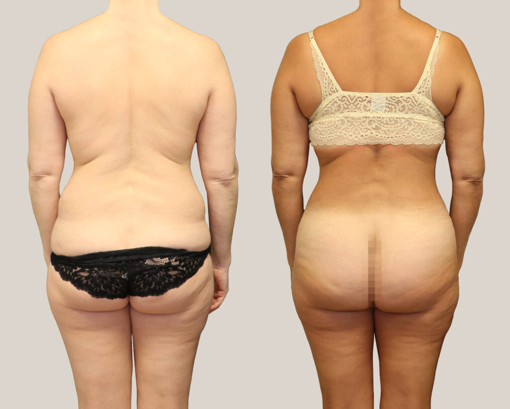 fettsugning-av-ryggparti-kvinna-bakifrån.
