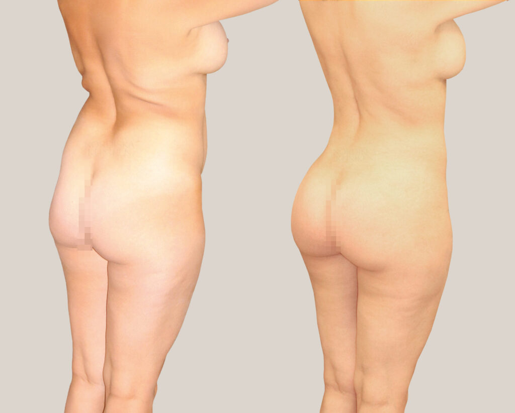 fettsugning- kvinna- bildgalleri-stuss