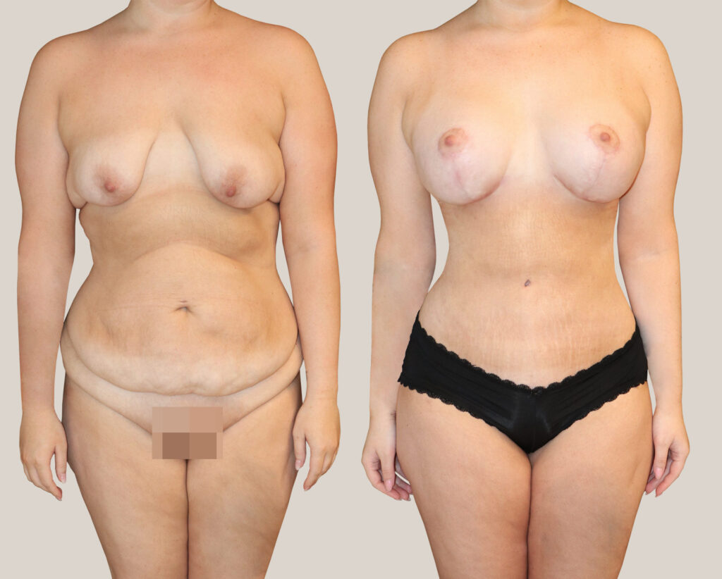 Bukplastik-bröstlyft-bildgalleri-framifrån-kvinna