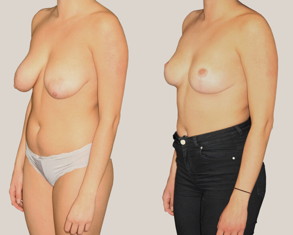 Ljus-kvinna-bröstlyft-grå-bakgrund