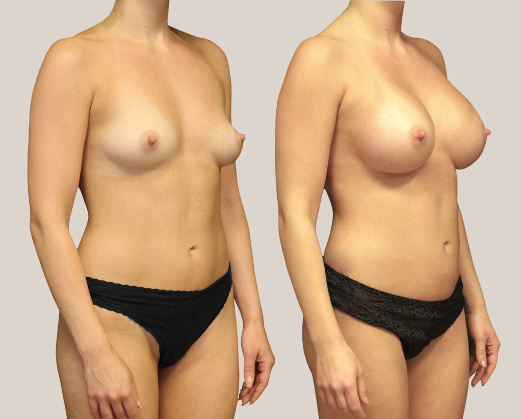 Bröstförstoring-450cc-kvinna-från-sidan-bildgalleri-före-och-efter