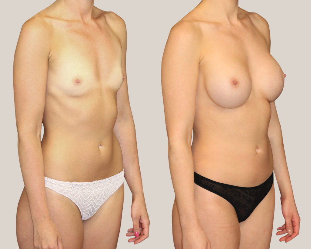 Bröstförstoring-500cc-kvinna-från-sida-bildgalleri-före-och-efter