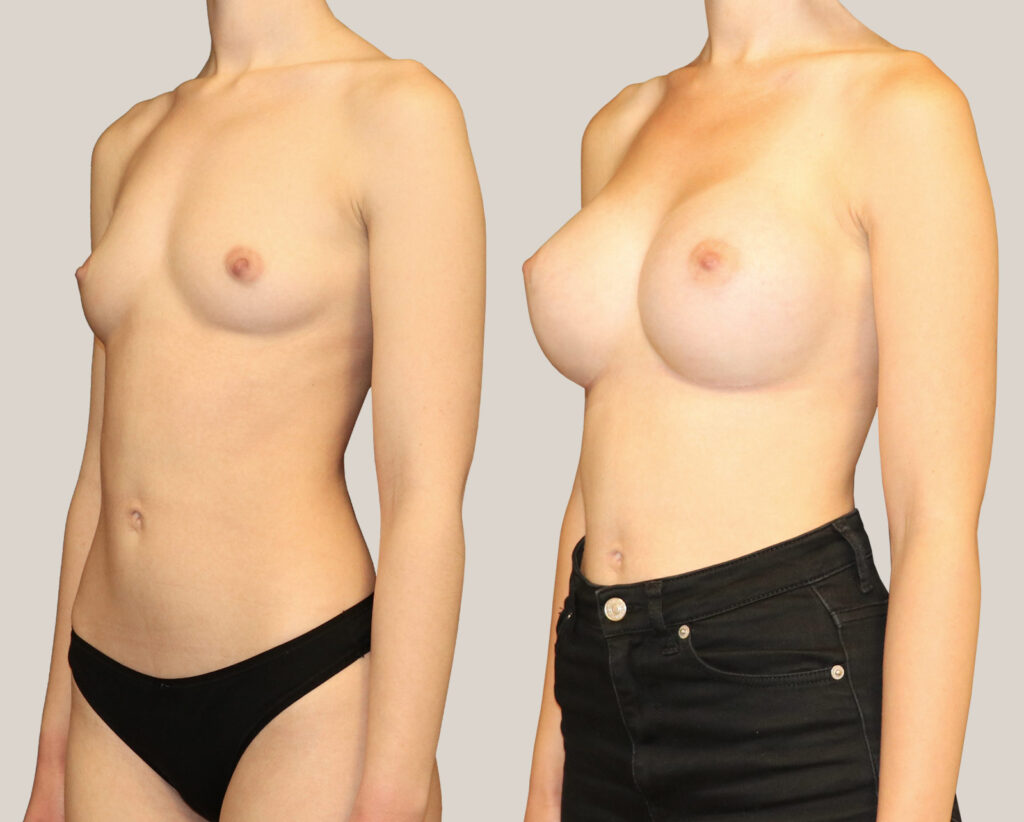 Bröstförstoring-425cc-kvinna-bildgalleri-före-och-efter