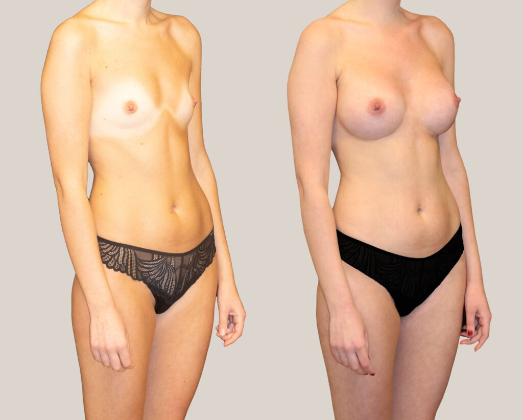 Bröstförstoring-400cc-kvinna-från-sidan-bildgalleri-före-och-efter