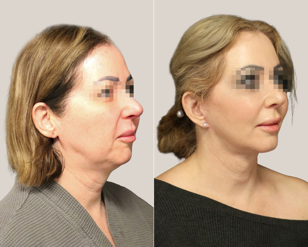 Facelift-kvinna-före-och-efter-bildgalleri