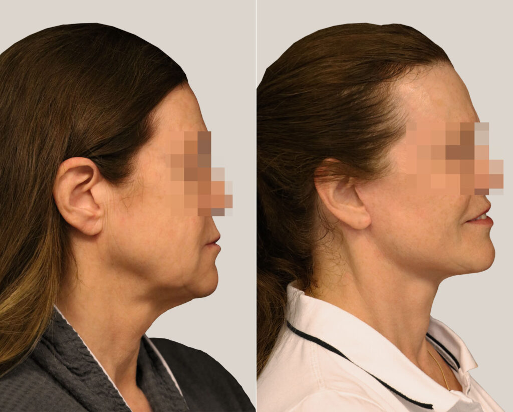 Facelift-bildgalleri-kvinna-före-och-efter
