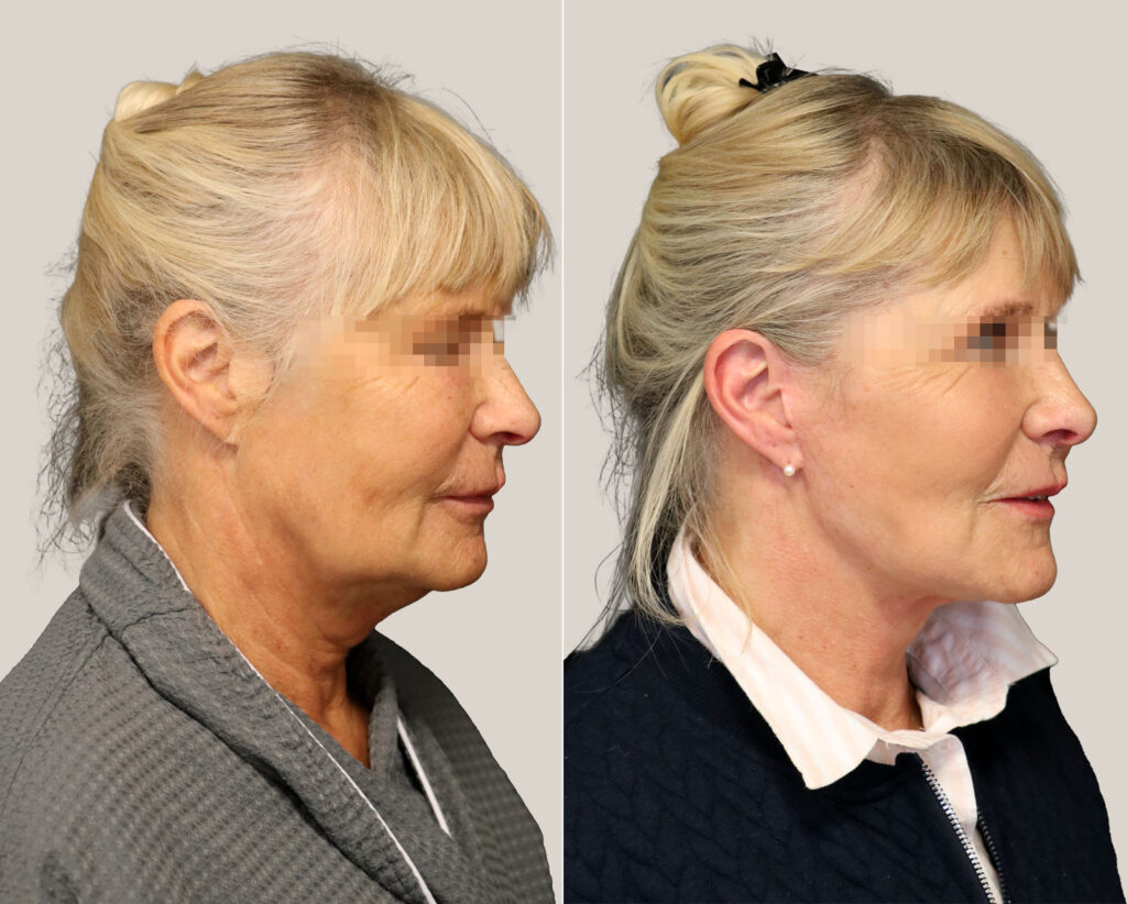 facelift-kvinna-bildgalleri