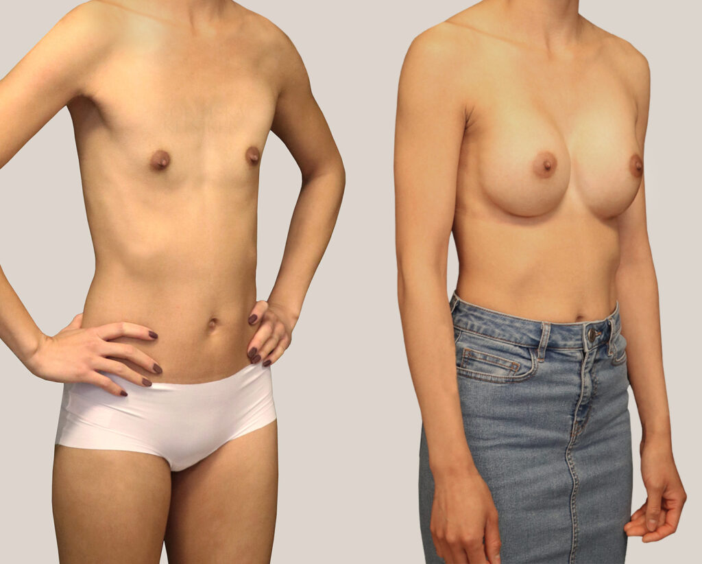 Bröstförstoring-360cc-kvinna-bildgalleri-före-och-efter