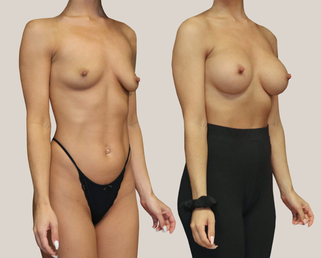Bröstförstoring-355cc-kvinna-från-sidan-bildgalleri-före-och-efter