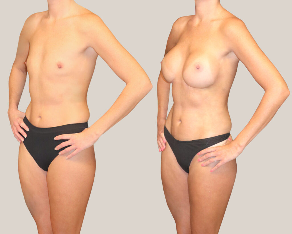 Bröstförstoring-500cc-kvinna-från-sidan-bildgalleri-före-och-efter