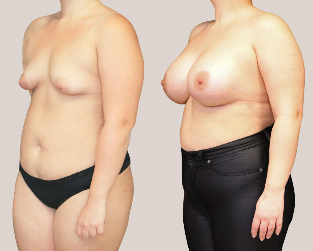 Bröstförstoring-725cc-kvinna-från-sidan-bildgalleri-före-och-efter