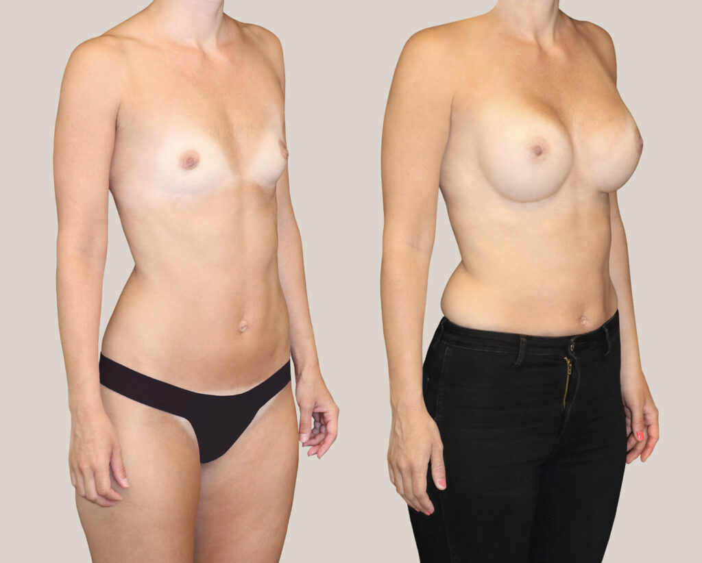 Bröstförstoring-500cc-kvinna-från-sidan-bildgalleri-före-och-efter