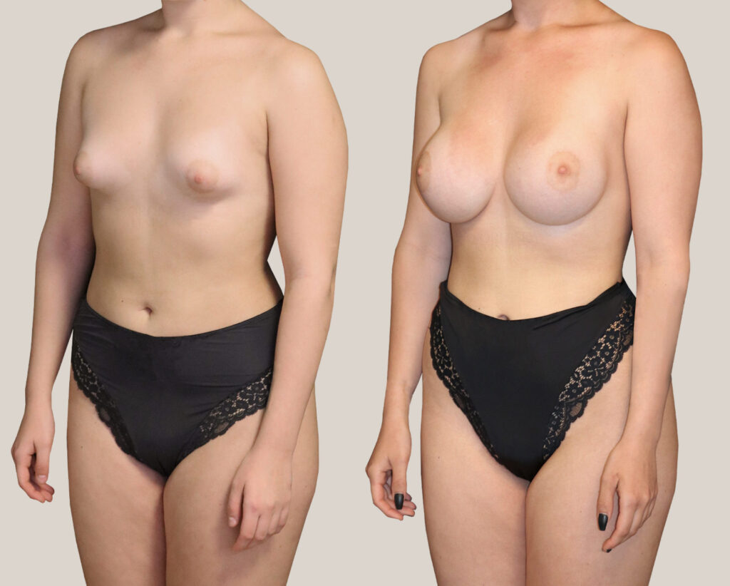 Bröstförstoring-450cc-kvinna-från-sidan-före-och-efter