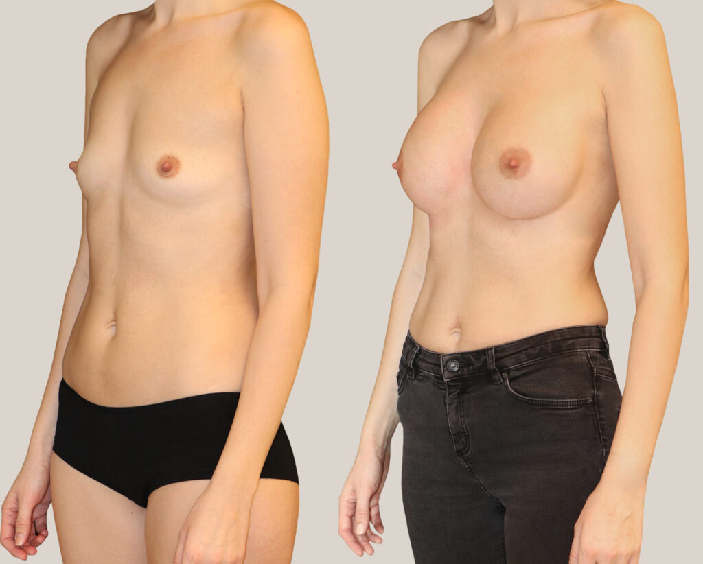 Bröstförstoring-380-kvinna-från-sidan-bildgalleri-före-och-efter