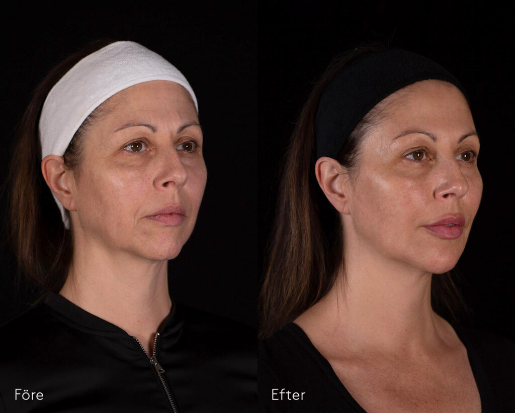 Fullface-bildgalleri-kombinationsbehandling-fillers-och-muskelavslappnanade medel-kvinna