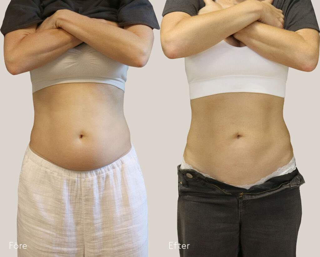 Bildgalleri-före-och-efter-Coolsculpting-kvinna-mage