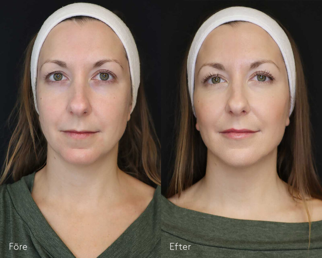 Fullface-kvinna-bildgalleri-före-och-efter-kombinationsbehandling-fillers-muskelavslappnanade-medel