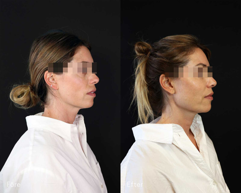 Fillersbehandling-kvinna-käklinje-haka-läppar-bildgalleri-före-och-efter