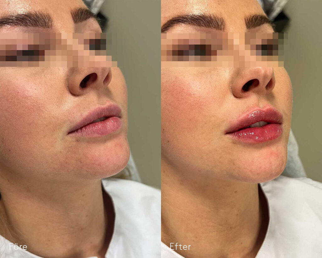 Fillersbehandling av läppar-kvinna-läppförstoring-bilfgalleri-före-och-efter