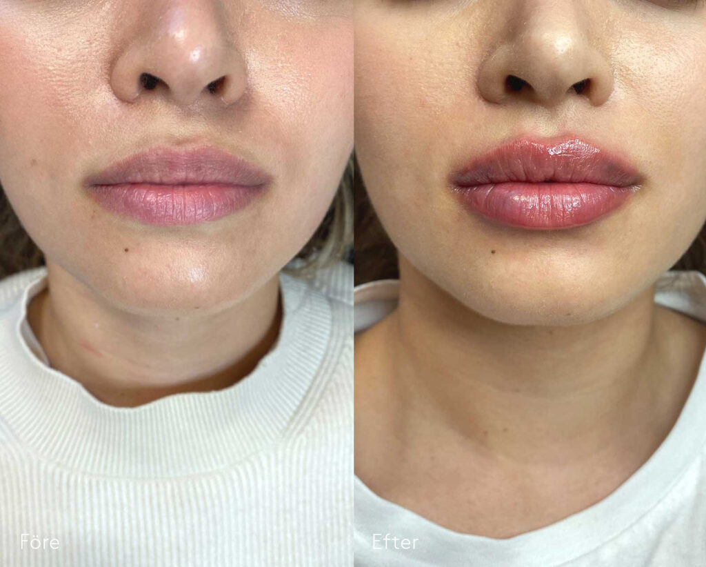 Fillersbehandling av läppar-bildgalleri-kvinna-före-och-efter-läppförstoring