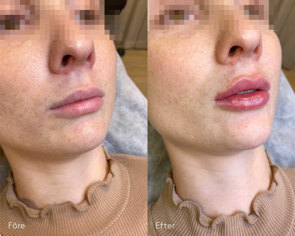 Fillersbehandling av läppar-kvinna-bildgalleri-före-och-efter