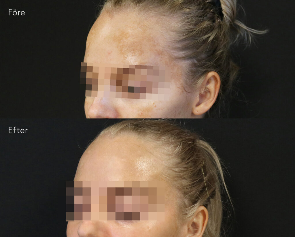 kvinna-ansikte_cosmelanbehandling-pigmenteringar-i-ansiktet