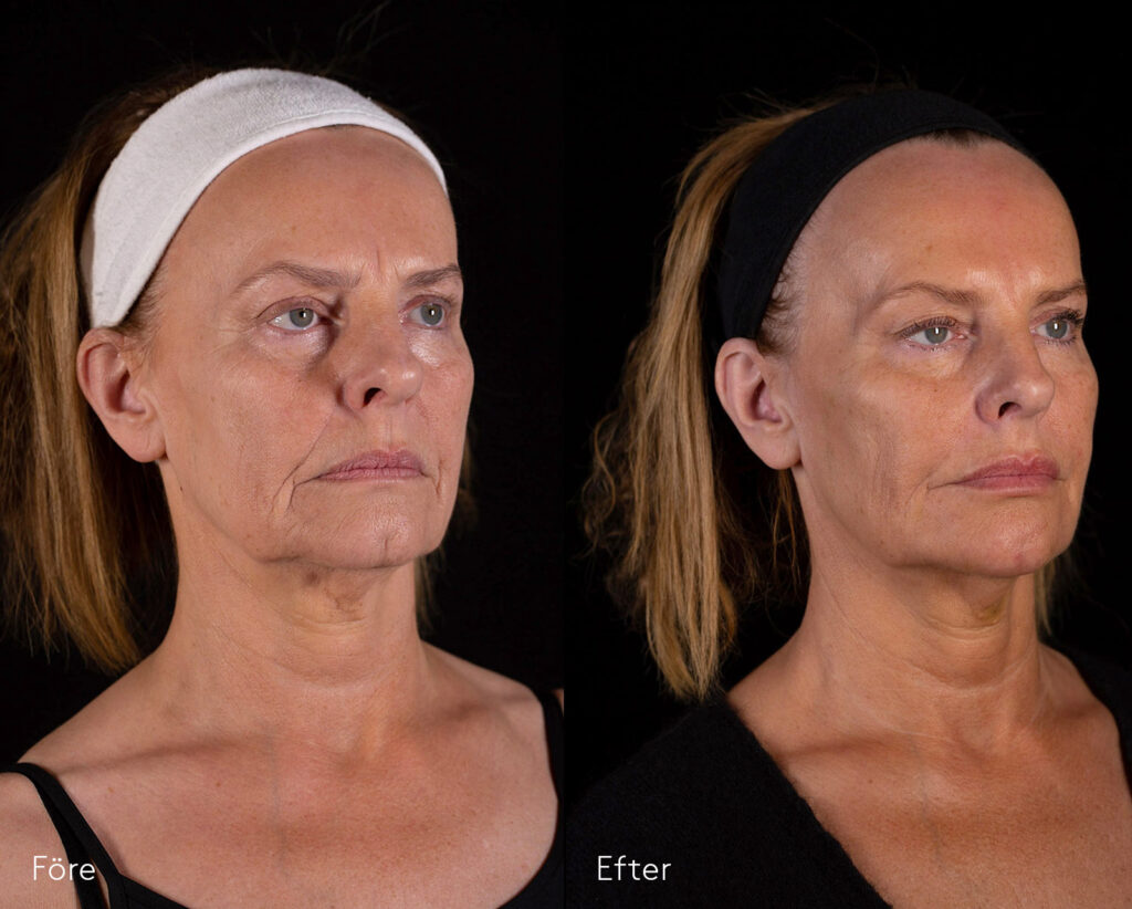Fullface-injektionsbehandling-kvinna-före-och-efter-bildgalleri