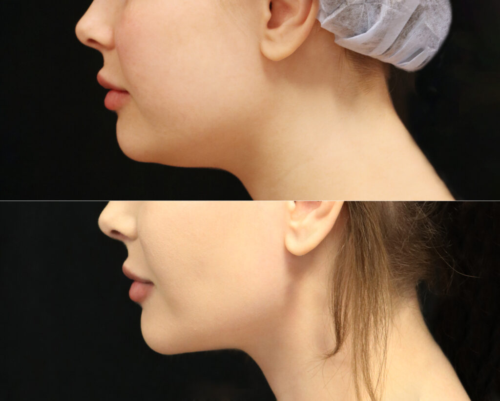 Buccal_fat_removal_fettsugning_hals