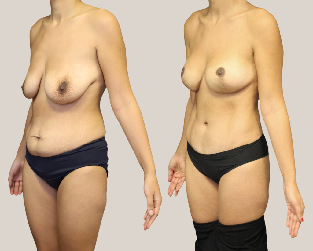 bukplastik_fettsugning_brostlyft_implantat
