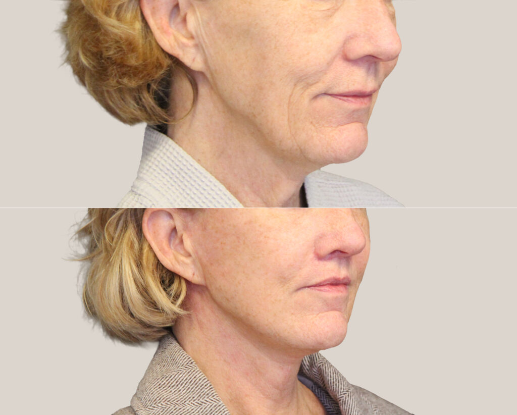 Deep-Plane Facelift + läpplyft