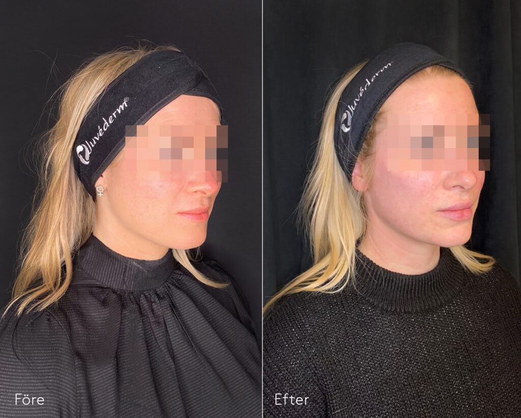 fillers_mellanansikte_kindben_lappar_botox_SS